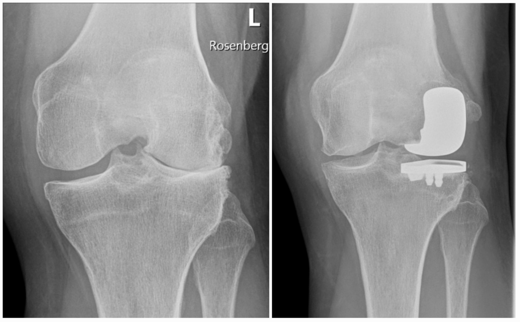 X-ray images of knee joint preop (left) and postop with sled prosthesis (right)