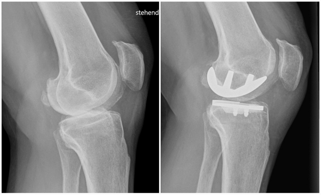 X-ray images of the sagittal knee joint preop (left) and postop with sled prosthesis (right)
