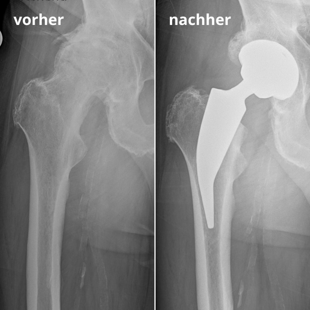 Auf der Röntgenaufnahme links sieht man die fortgeschrittene Coxarthrose und rechts, den erfolgreichen Einsatz einer Kurzschaftprothese im Hüftgelenk. 