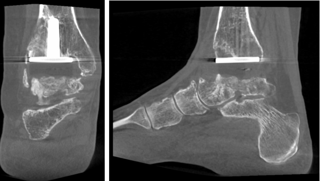 Patientenstory: Arthrodese mit 20 Jahren? Muss nicht sein!   Internationales Zentrum fr Orthopdie  ATOS Klinik Heidelberg