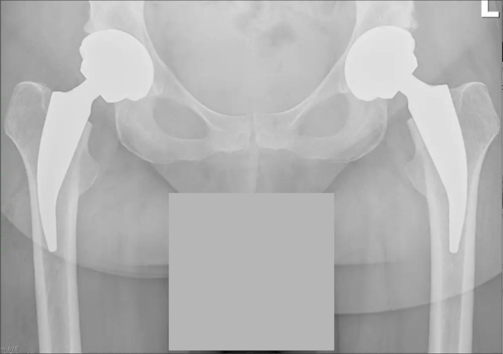 Beidseitige einzeitige Hüftoperation. Beide von der Arthrose geschädigten Hüftgelenke wurden in nur einer Ooperation ausgetauscht. Prof. Thorey