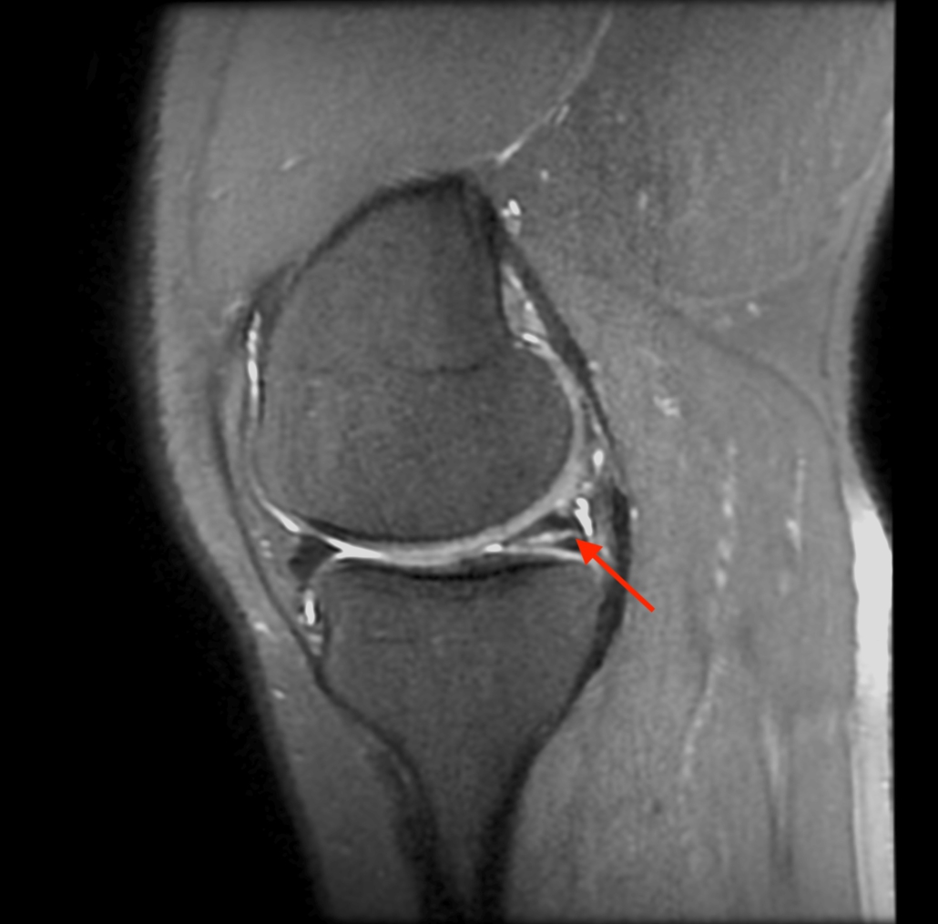 MRT Bild des gerissenen Meniskus.